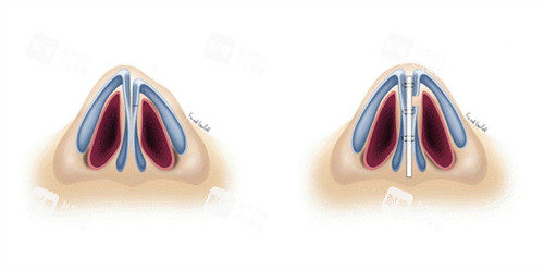 常州谢院美袋整形怎么样？专注眼袋整形与微整注射，不开刀去眼袋结果自然更安心！