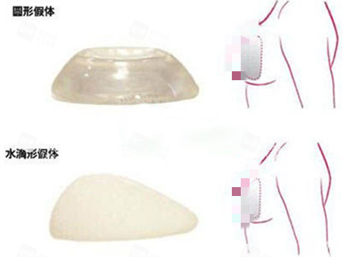 不外形假体示意图 不外形假体示意图