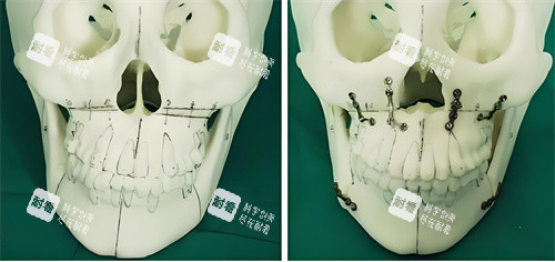正颌手术手术原理展示图 正颌手术手术原理展示图