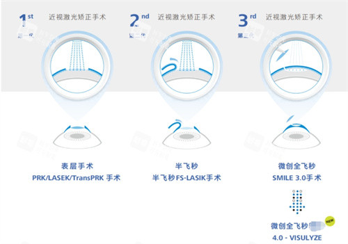 全飞秒4.0技术与其他技术对比