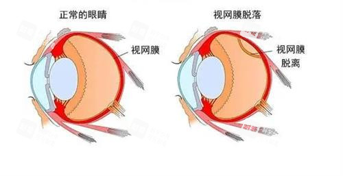 视网膜脱落的眼睛和正常眼睛的对比 视网膜脱落的眼睛和正常眼睛的对比