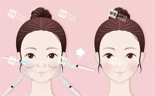 馒化针注射照片 馒化针注射照片