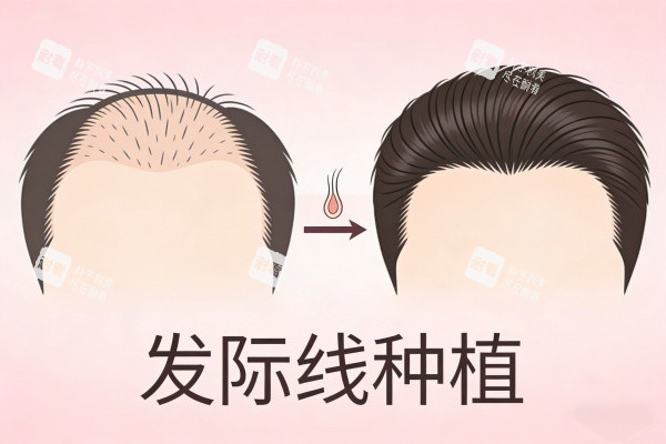 发际线种植前后对比图展示 发际线种植前后对比图展示