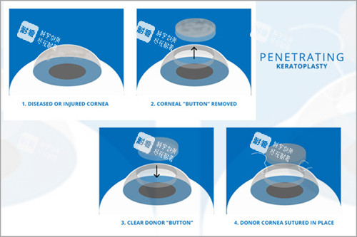 角膜移植过程图示 角膜移植过程图示