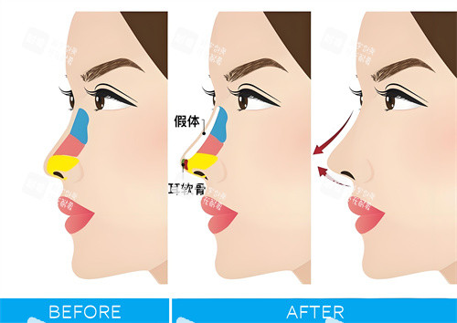 隆鼻手术图解动画图 隆鼻手术图解动画图