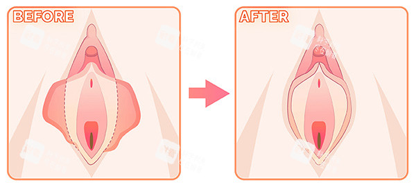 阴唇整形前后对比变化