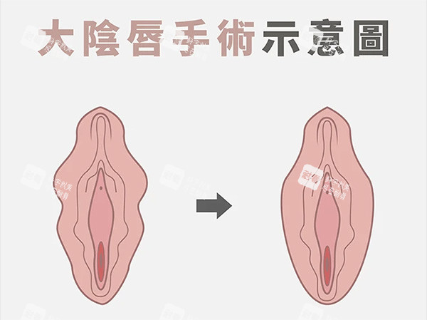 大阴唇整形前后照片