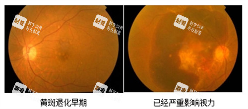 黄斑病变早期和重度