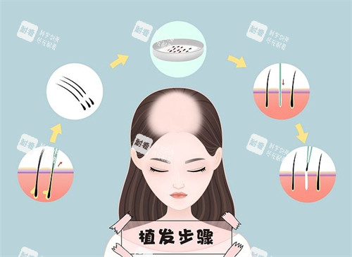 植发步骤