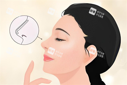 假体隆鼻卡通图 假体隆鼻卡通图