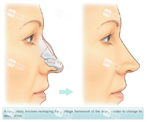 假体隆鼻 假体隆鼻