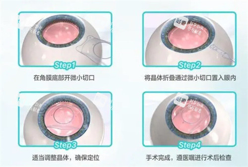 晶体植入的过程