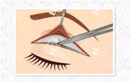 双眼皮肉条修复术