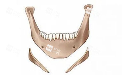 下颌角长曲线截骨示意图