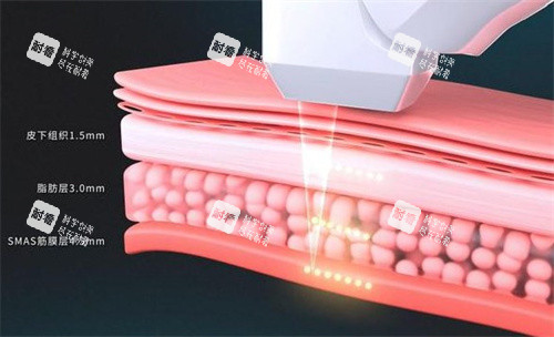 超声炮治疗深度 超声炮治疗深度