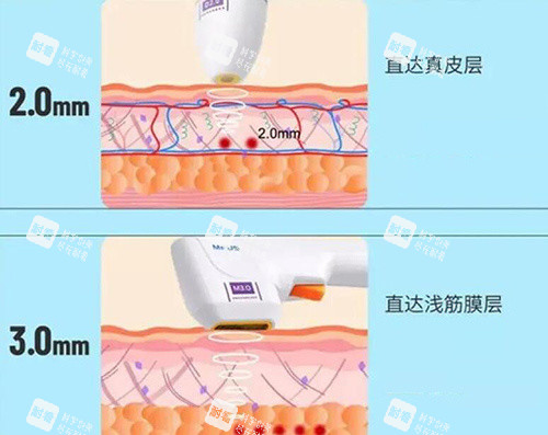 半岛超声炮探头展示图 半岛超声炮探头展示图