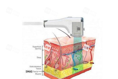 超声炮改善作用展现 超声炮改善作用展现