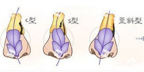 唇腭裂鼻子坍塌