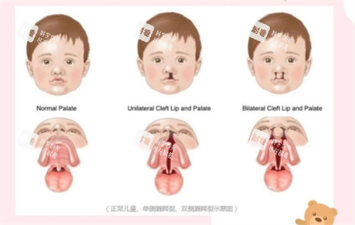 唇腭裂不同程度