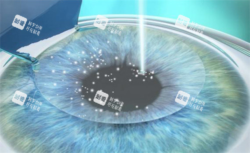 全飞秒手术原理