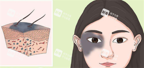 祛斑术 祛斑术
