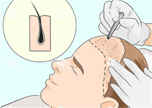 微针植发过程图解 微针植发过程图解