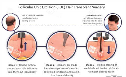 FUE手术过程 FUE手术过程