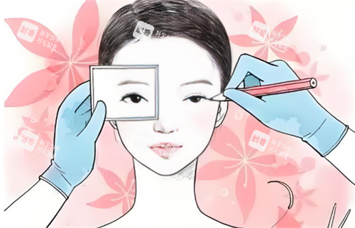 双眼皮手术过程