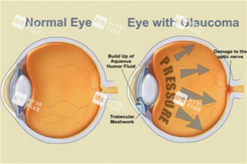青光眼示意图