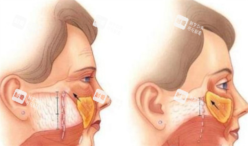 拉皮手术前后对比