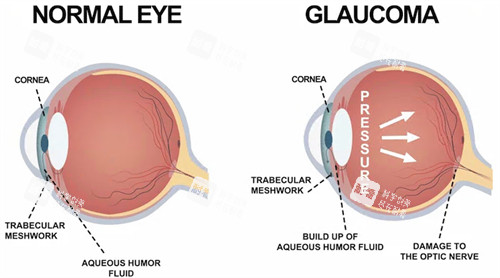 青光眼和正常眼睛对比 青光眼和正常眼睛对比