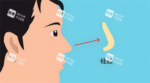 硅胶假体隆鼻 硅胶假体隆鼻