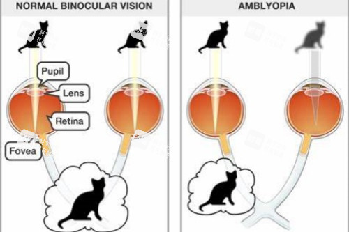正常眼与弱视眼视物对比图