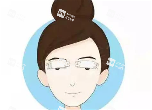 双眼皮术后