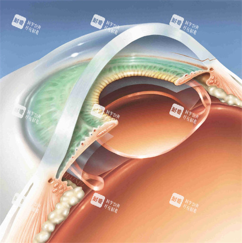 眼睛植入晶体 眼睛植入晶体