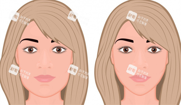 面部轮廓整形手术前后对比