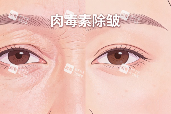 注射针剂除皱前后对比图 注射针剂除皱前后对比图