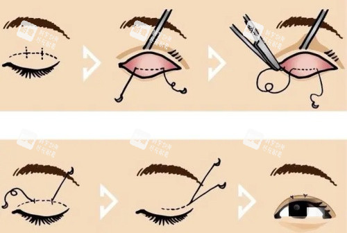 双眼皮操作示意图 双眼皮操作示意图