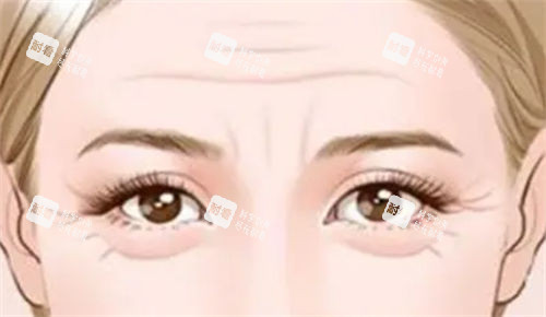 泪沟型眼袋和眼角细纹展示图 泪沟型眼袋和眼角细纹展示图