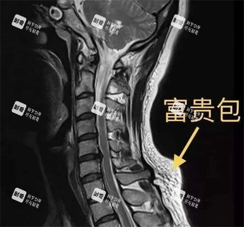 CT下的富贵包图示