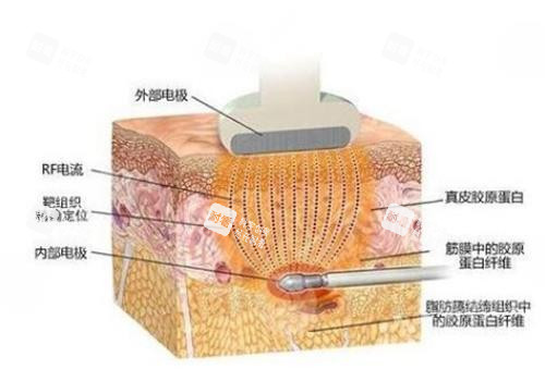黄金微雕的作用