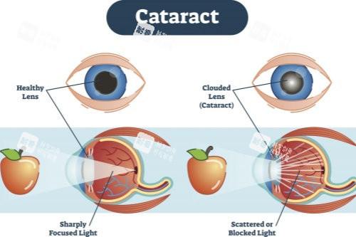 正常眼睛与白内障眼睛视物对比图 正常眼睛与白内障眼睛视物对比图