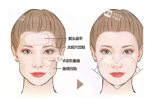面部轮廓填充前后对比