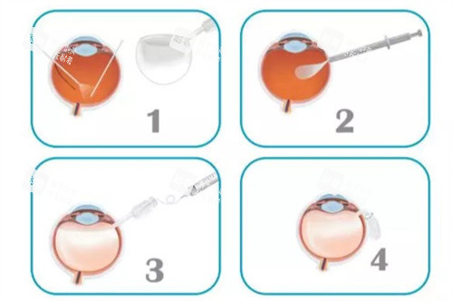 人工玻璃体植入手术过程 人工玻璃体植入手术过程
