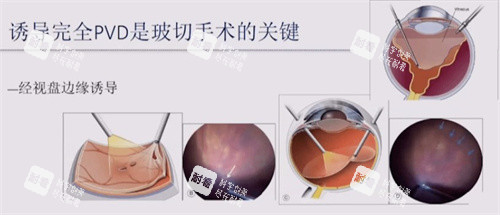 玻璃体切除手术 玻璃体切除手术