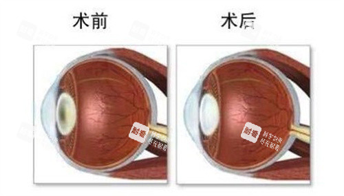 人工玻璃体植入手术前后 人工玻璃体植入手术前后