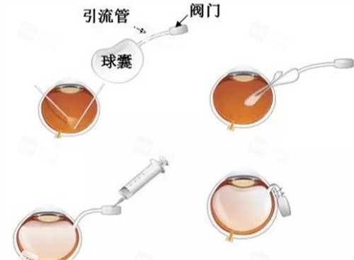 人工玻璃体植入手术 人工玻璃体植入手术