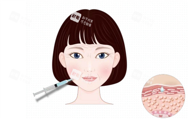 面部注射除皱卡通图