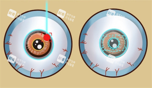 近视手术不同种类的眼球表现 近视手术不同种类的眼球表现