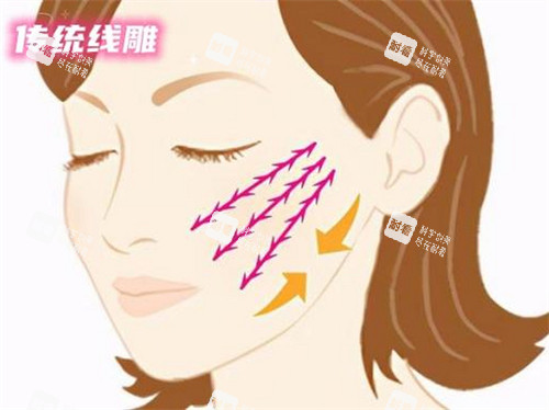 苹果肌线雕提升术动画演示图